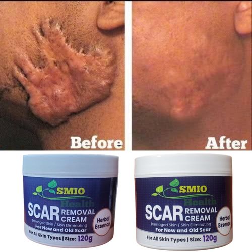 SMIO HEALTH Rapid Scar Remover Old And New Scars Achieve Smooth, Scar-Free Skin 120g
