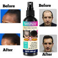 Kirkland Minoxidil Rapido Hair Root Activator Spray – Powered By Minoxidil 5% For Fast, Clinical-Strength Results 100ml