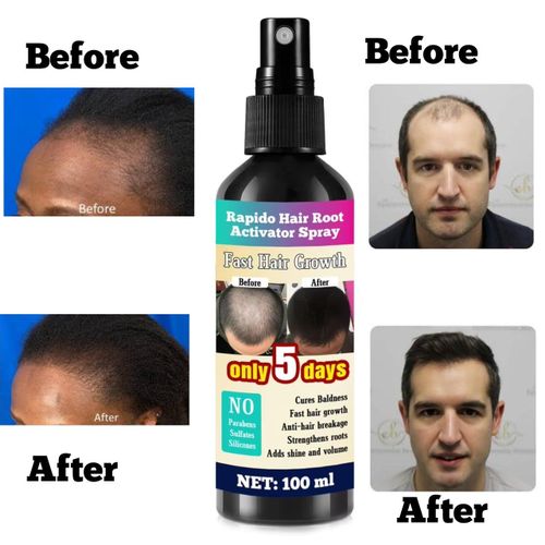 Kirkland Minoxidil Rapido Hair Root Activator Spray – Powered By Minoxidil 5% For Fast, Clinical-Strength Results 100ml