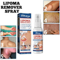 Sumifun Lipoma Remover Spray 50ml