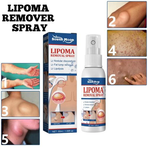 Sumifun Lipoma Remover Spray 50ml